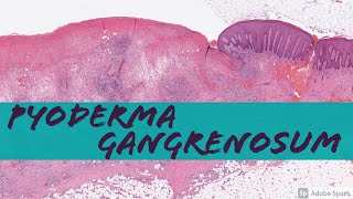 Pyoderma Gangrenosum vs NonSpecific Chronic Ulcer Changes [upl. by Telrats]