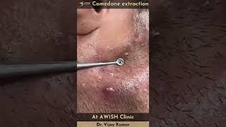 Comedone extraction  extract Comedones  extraction facial at AWISH clinic [upl. by Adaner]