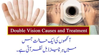 Double Vision Causes and Treatment  UrduHindi [upl. by Ku]