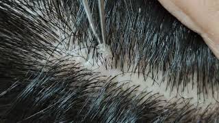 Relaxing dandruff removal w tweezers 15 02sleepyheads  visual ASMR oddlysatisfying [upl. by Edlitam]