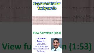 Supraventricular Tachycardia [upl. by Caine]