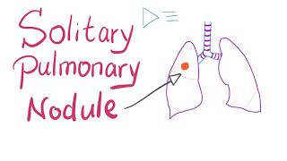 Solitary Pulmonary Nodule SPN How to manage it [upl. by Ylrebmi]