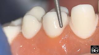 Stepbystep crown preparation for upper premolar Препарирование под коронку верхнего премоляра [upl. by Acirdna]