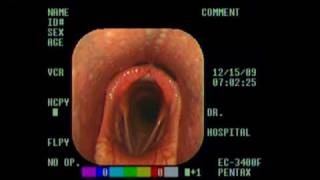 Normal Larynx mpg [upl. by Mccomb655]