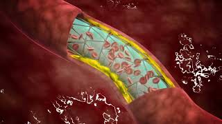 Transcarotid Artery Revascularization TCAR [upl. by Aydni]