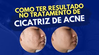 Como ter Resultado no Tratamento de Cicatriz de Acne [upl. by Schargel]