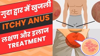 गुदा द्वार के खुजली का आसान इलाजFungal InfectionItchy anus fungalinfection treatment [upl. by Niddala]