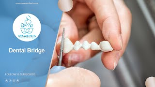 Dental Bridge in Turkey 5 Days  Turk Aesthetic [upl. by Arehsat]