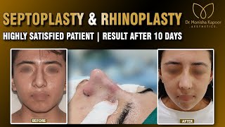 Bulbous Nose to Beautiful Nose Transformation  Rhinoplasty Nose Before amp After  Dr Monisha Kapoor [upl. by Mauceri]