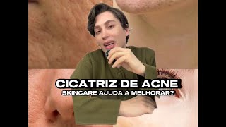 Cicatriz de acne Será que a skincare consegue te ajudar Vem saber quais as minhas dicasSkincare [upl. by Amej]