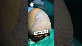 Hair Transplant Result  IFUE Hair Transplant Before amp After  4200 Grafts Hair Transplant Result [upl. by Carie]