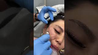 Under Eyes amp Temple Filler Treatments by Dr TJ Tsay  Ageless MD [upl. by Athena]