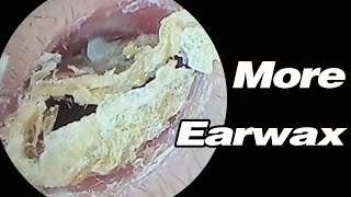 Ear Picking Earwax Is Super Heavy And Its Blocking My HearingASMRearwax耳掃除 [upl. by Noraed]