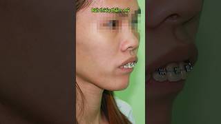 Buck teeth braces braces orthodontist dental dentistry niengrang [upl. by Rauscher]