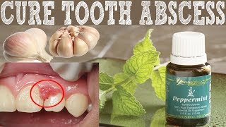 How To Cure Tooth Abscess naturally  Home Remedies To Cure Tooth Abscess [upl. by Latia76]