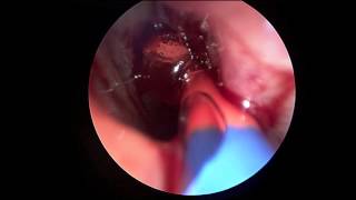 Maxillary Sinus Office Balloon Dilation and Drainage with Entellus 2015 [upl. by Radbun894]