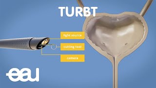 Bladder cancer treatment TURBT [upl. by Lahey]