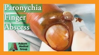 Paronychia Fingernail Abscess Infection Treatment  Auburn Medical Group [upl. by Tychon]