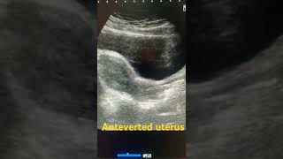 Anteverted uterus ultrasound shortfeed medical uterus pelvic pelvis study shortsviral short [upl. by Adnuhsar]