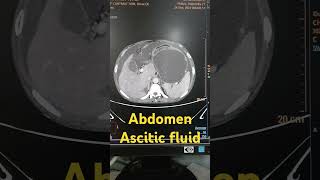 Abdomen ascitic fluid abdomen abdomenascitic shorts viralshorts [upl. by Mann926]