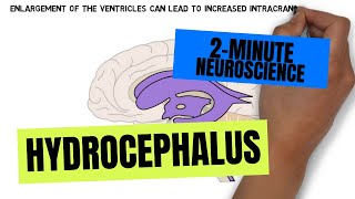 2Minute Neuroscience Hydrocephalus [upl. by Aleel]