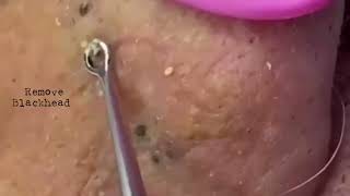 Acne Removal Remove blackhead on his lips noses removeblackhead [upl. by Nallek]