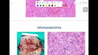 MSS pathology lab 1  part 4 [upl. by Ahcila]