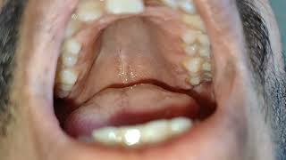 HighArched Palate Examination [upl. by Hasin]