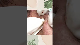 Big Cystic Acne Blackheads Extraction Blackheads amp Milia Whiteheads Removal Pimple Popping shorts [upl. by Lyndel]