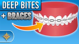 How Do Braces Fix Deep Bites  Premier Orthodontics [upl. by Robbie]