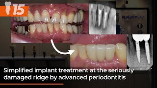 Simplified implant treatment at the seriously damaged ridge by advanced periodontitis 15th [upl. by Shina]