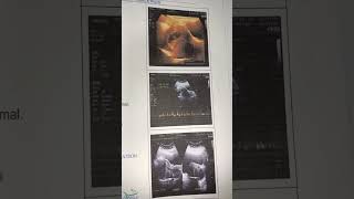 My pregnancy scan report  7th week scan ultrasound Scan pregnancy pregnancyscan [upl. by Atsirk]