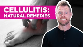 Are There Natural Remedies for Cellulitis [upl. by Sapowith]