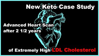 New Case Study  High LDL Cholesterol Low Saturated Fat But What About Heart Disease… [upl. by Anoyet]