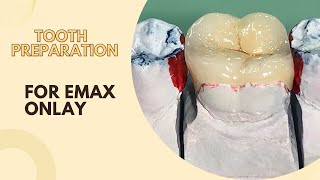 Onlay Tooth Preparation Indirect Restoration Part 1 [upl. by Dun658]