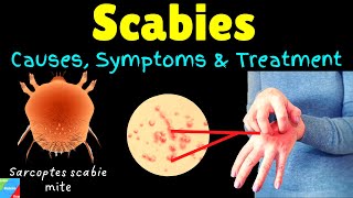 Scabies Causes Symptoms Diagnosis Treatment amp Prevention [upl. by Nicoli]