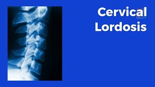 Cervical Lordosis  What Is It and What Is It And Why Is It Important  Tebby Clinic [upl. by Capello]