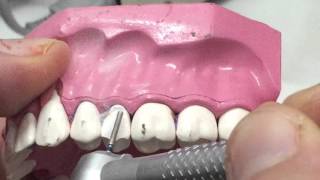 PFM second premolar preparation 1 [upl. by Aramoix]