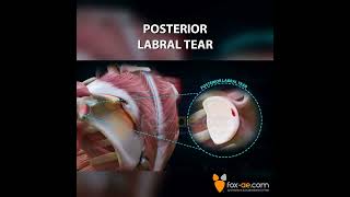 Posterior Labral Tear [upl. by Aneelad686]