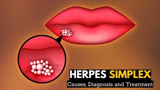 Herpes Simplex Causes Signs and Symptoms Diagnosis and Treatment [upl. by Draude733]