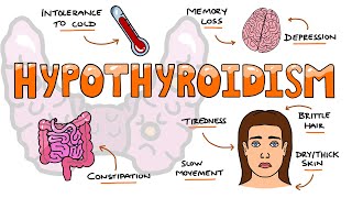 Hypothyroidism Signs and Symptoms Mnemonic  MOMS SO TIRED [upl. by Concepcion]