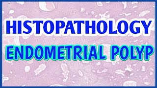 ENDOMETRIAL POLYP  HISTOPATHOLOGY  PathTube [upl. by Nevsa]