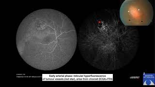 Exudative Retinal Detachment A Clinical Approach by Dr Richa 28 Nov 2020 [upl. by Cassi]