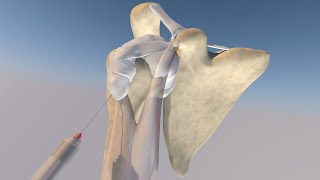 Anatomic Model of a Bicipital Sheath Injection by probeultrasound [upl. by Lydie]