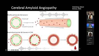 Amyloidrelated Imaging Abnormalities Casebased Approach [upl. by Breban119]