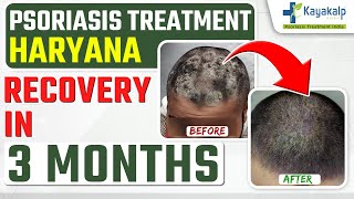 Scalp Psoriasis Treatment  3 Months Recovery  How to heal Scalp Psoriasis Permanently [upl. by Annissa]