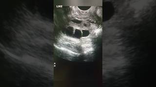 Polycystic ovaries Ultrasound after Ovulation inductionfypviraltrendingshortsforyousubscribe [upl. by Korey579]