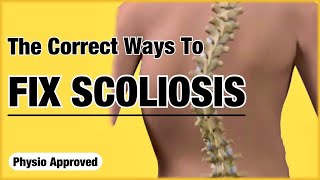 Fix Scoliosis Without Surgery  Recommended By A Physio [upl. by Oluas]