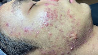 ACNE TREATMENT VU QUYNH MI  Blackheads On Boy Face 2024FULL [upl. by Gentes]