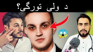 Why Eyes dark circles create Periorbital Hyperpigmentation in Pashto by Dr Mustaqeem [upl. by Leoy19]